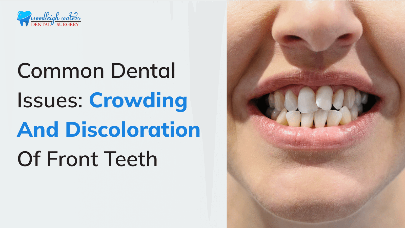 Freed Teeth Problem Crowding and Discoloration of Front Teeth - Common Dental Issues